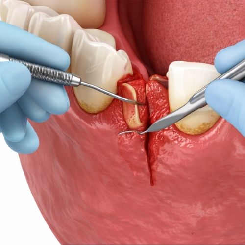 Surgical Gum Treatment (Only if Needed)